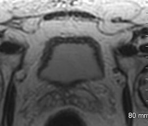 diverticules intrapariétaux