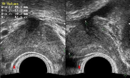 mesure du volume prostatique