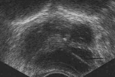 abces prostate echographie