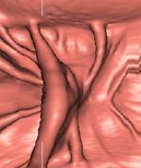 Valvule iléo-caecale papillaire, vue 3D