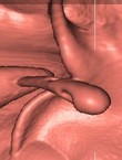 Sonde ballonnet rectum, vue 3D