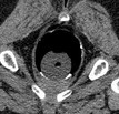 Rectum, vue 2D