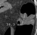 Adénocarcinome, vue 2D