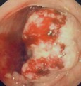 Adénocarcinome, vue endoscopique