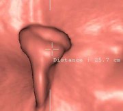 Volumineux polype, vue 3D. À l'histologie : adénome mixte.