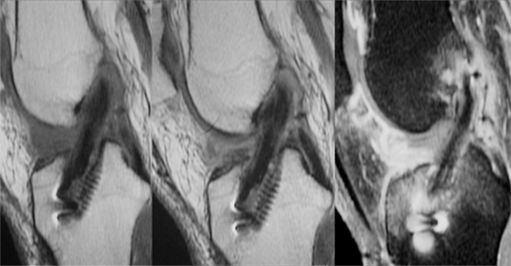 arthrofibrose