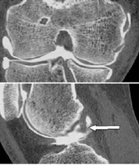 rupture complète