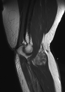 sagittal T1 gado