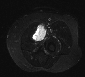 axial STIR