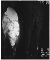 coroSTIR