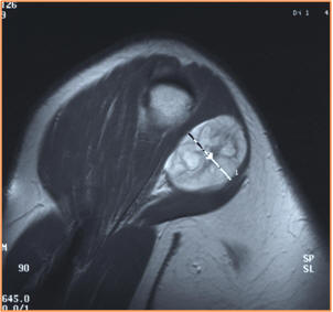 sagittal T1 gado