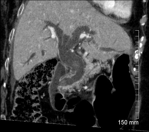 Angiocholite Aigue Bact rienne
