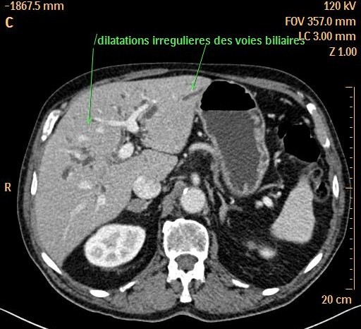 Angiocholite Aigue Bact rienne