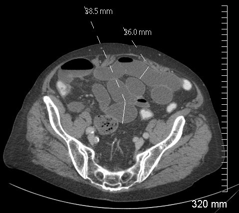 Occlusion Intestinale Aigue Occlusion Intestinale Aigue