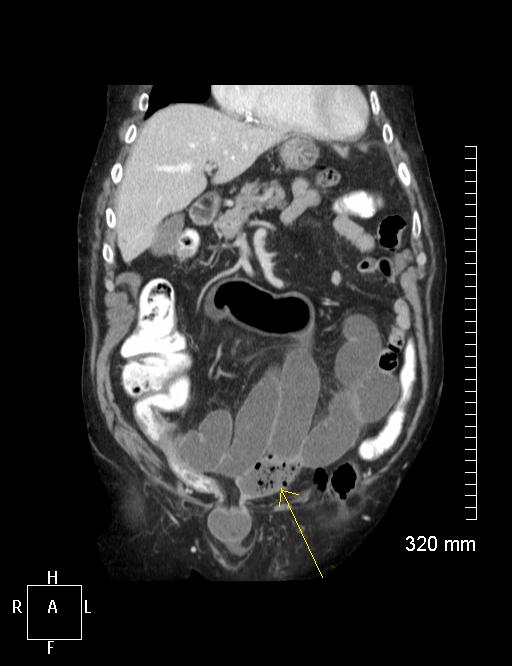 Occlusion Intestinale Aigue Occlusion Intestinale Aigue