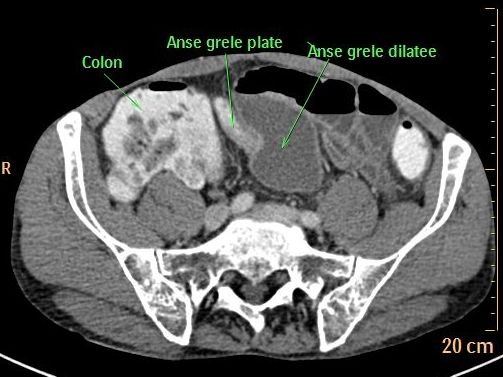 Occlusion Intestinale Aigue Occlusion Intestinale Aigue