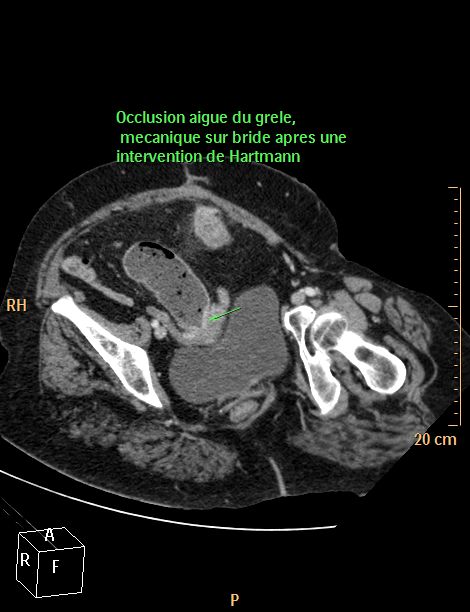 S miologie TDM Des Complications Communes S miologie TDM Des Complications Communes