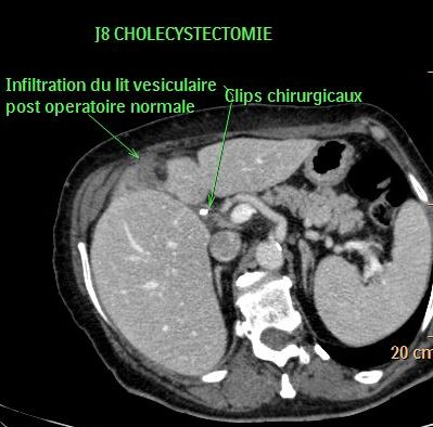 post_cholecystectomie_normale