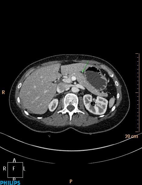 ANATOMIE ET RADIOANATOMIE DU PANCREAS ANATOMIE ET RADIOANATOMIE DU PANCREAS