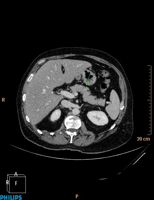 PANCREATITE AIGUE PANCREATITE AIGUE
