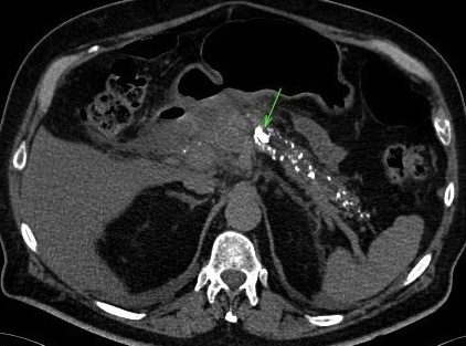 PANCREATITE CHRONIQUE PANCREATITE CHRONIQUE