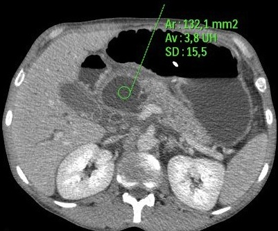 PANCREATITE CHRONIQUE PANCREATITE CHRONIQUE